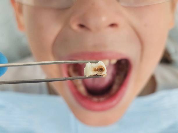 Best Teeth Whitening  in Polson, MT
